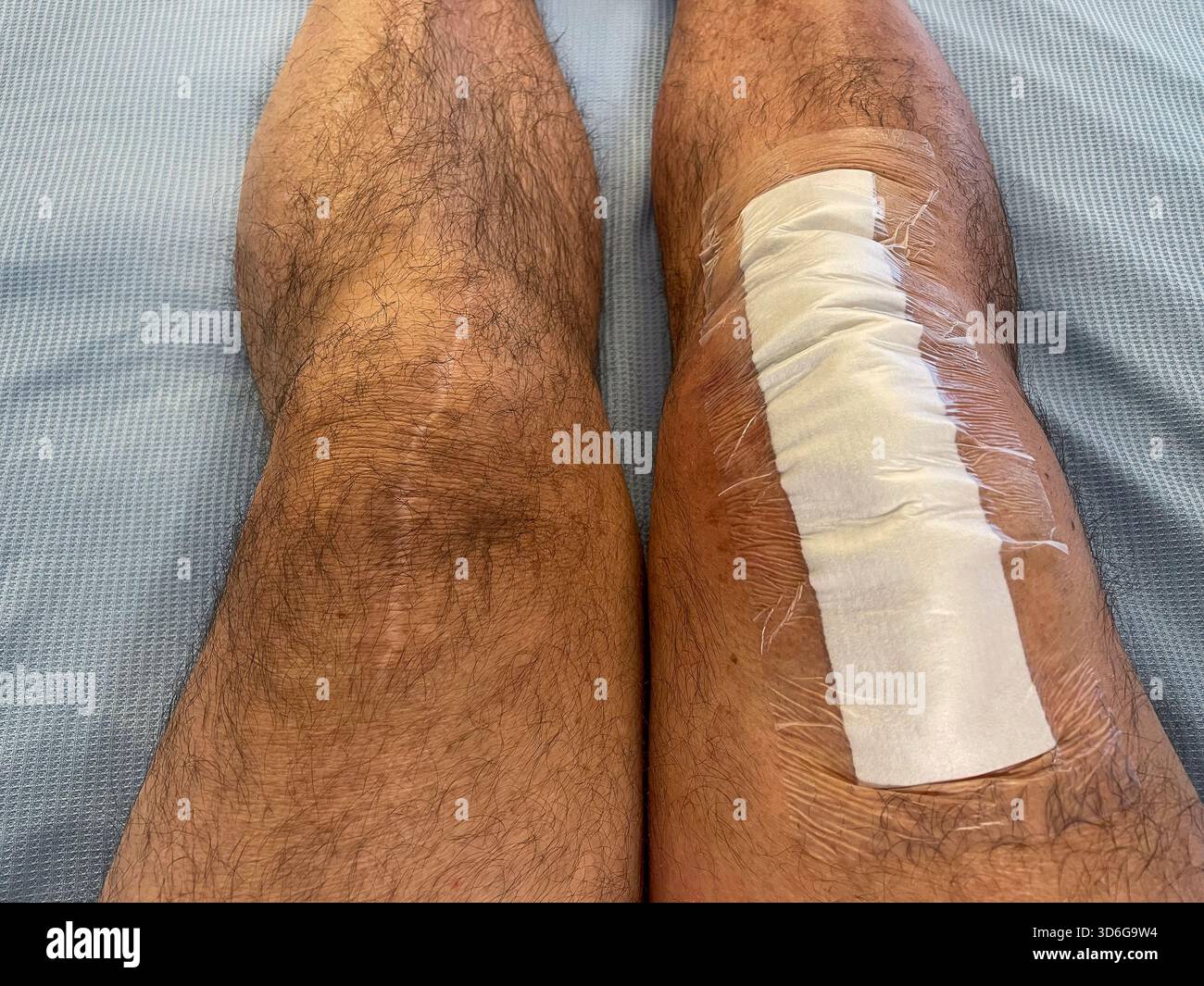 Clinical post-operative knee replacement with neatly aligned surgical staples on a healing midline incision: Phillip Roberts - Smartphone Captured Stock Image