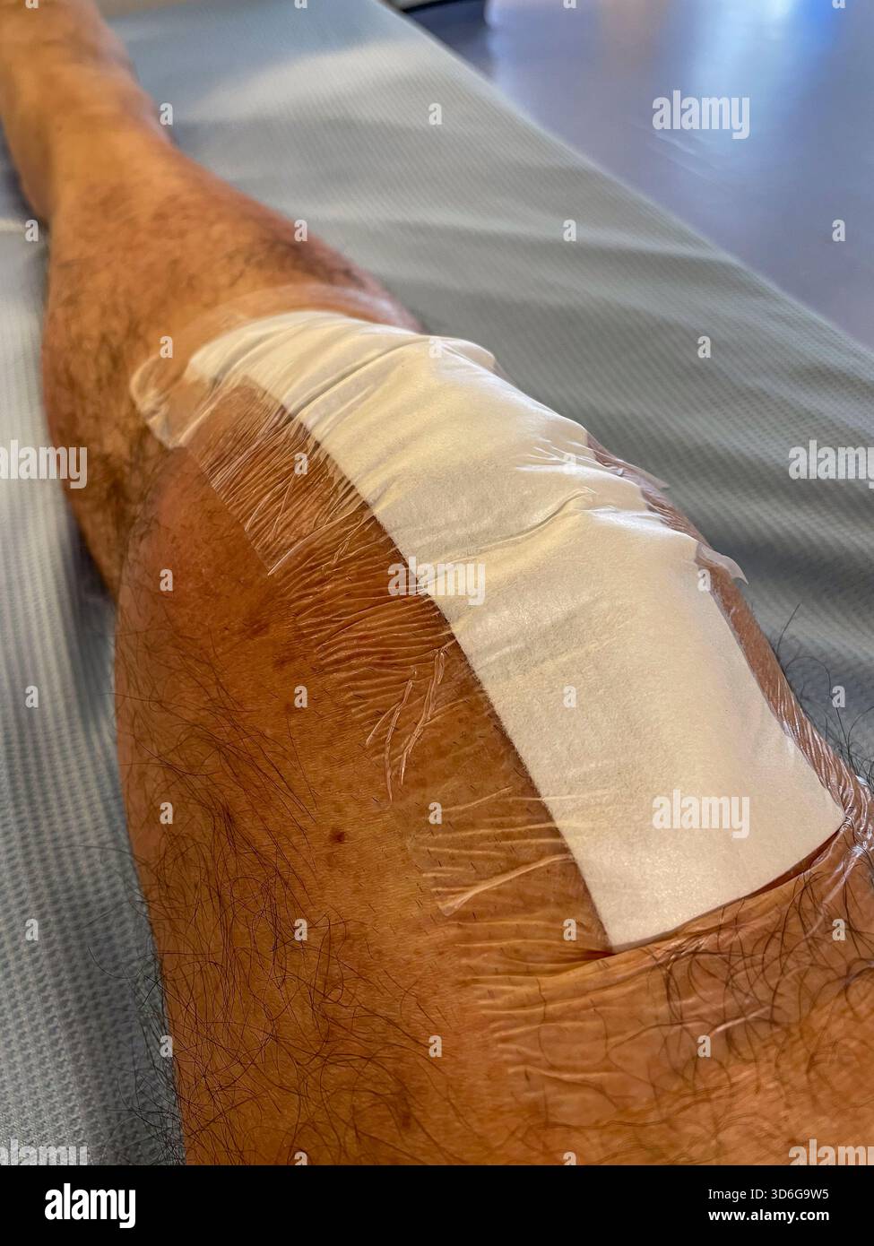 Clinical post-operative knee replacement with neatly aligned surgical staples on a healing midline incision: Phillip Roberts - Smartphone Captured Stock Image
