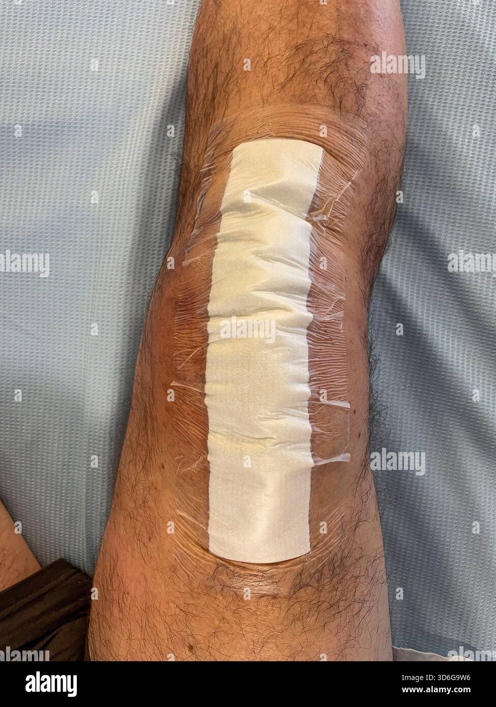 Clinical post-operative knee replacement with neatly aligned surgical staples on a healing midline incision: Phillip Roberts - Smartphone Captured Stock Image