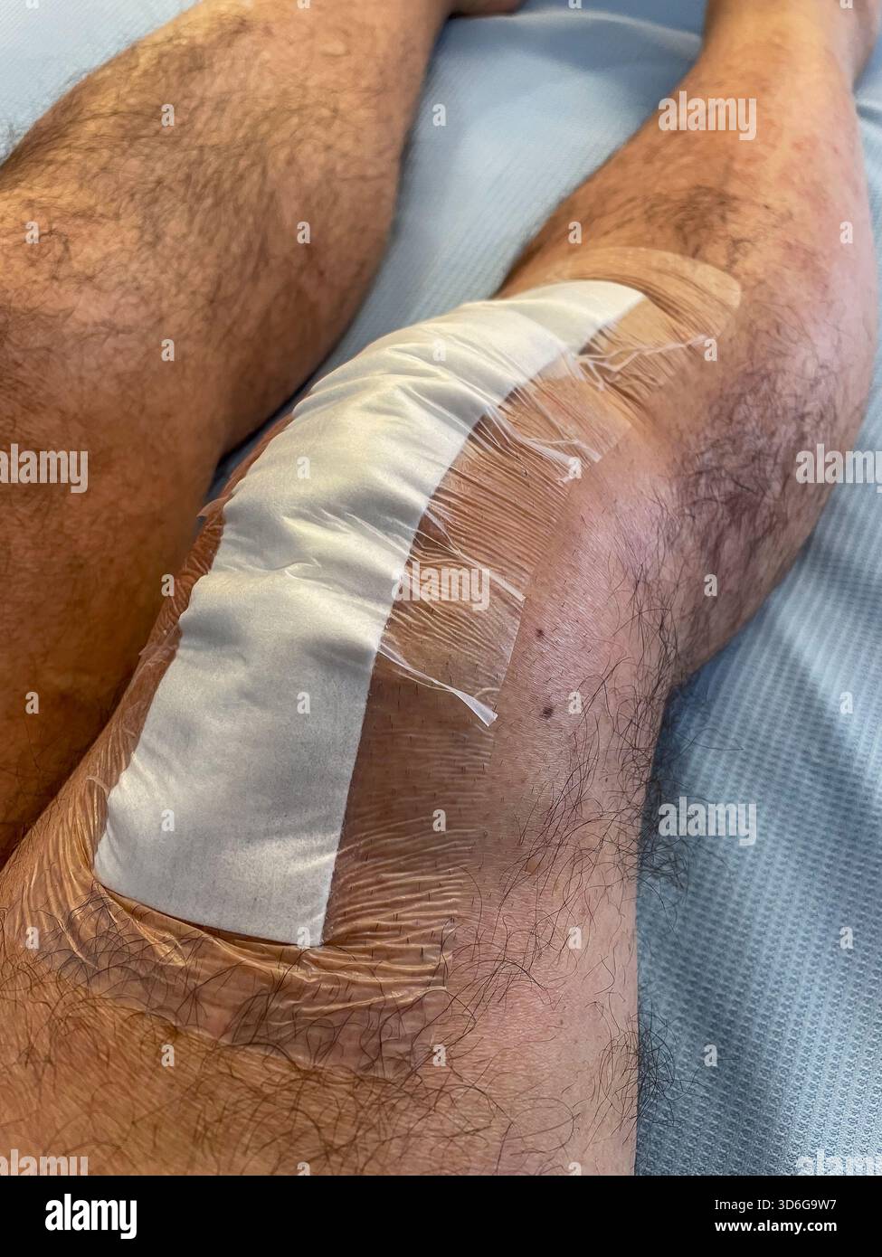 Clinical post-operative knee replacement with neatly aligned surgical staples on a healing midline incision: Phillip Roberts - Smartphone Captured Stock Image