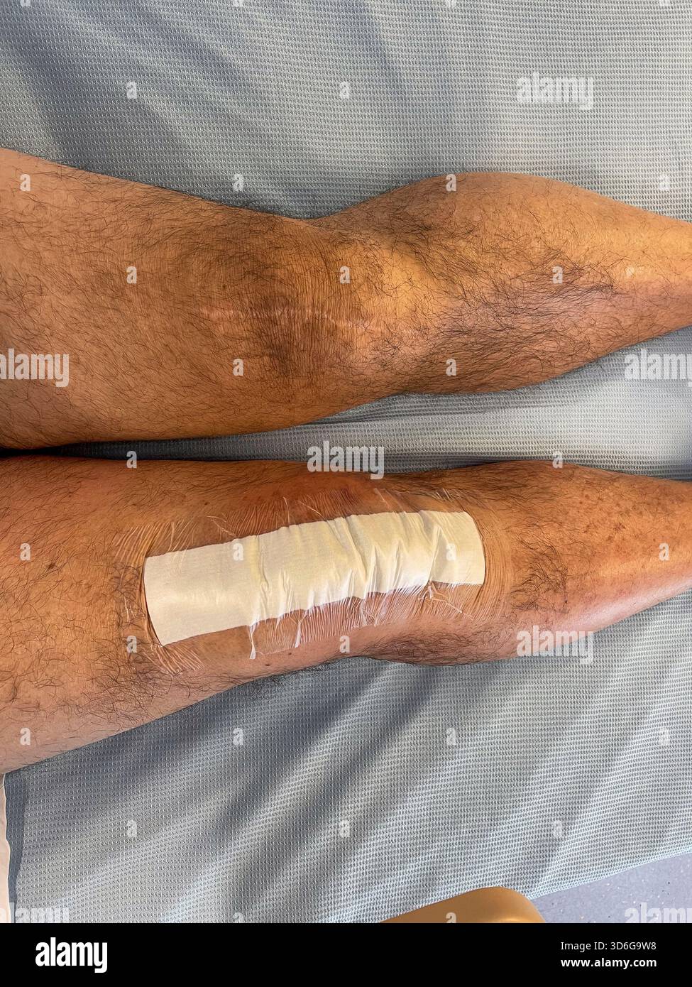 Clinical post-operative knee replacement with neatly aligned surgical staples on a healing midline incision: Phillip Roberts - Smartphone Captured Stock Image