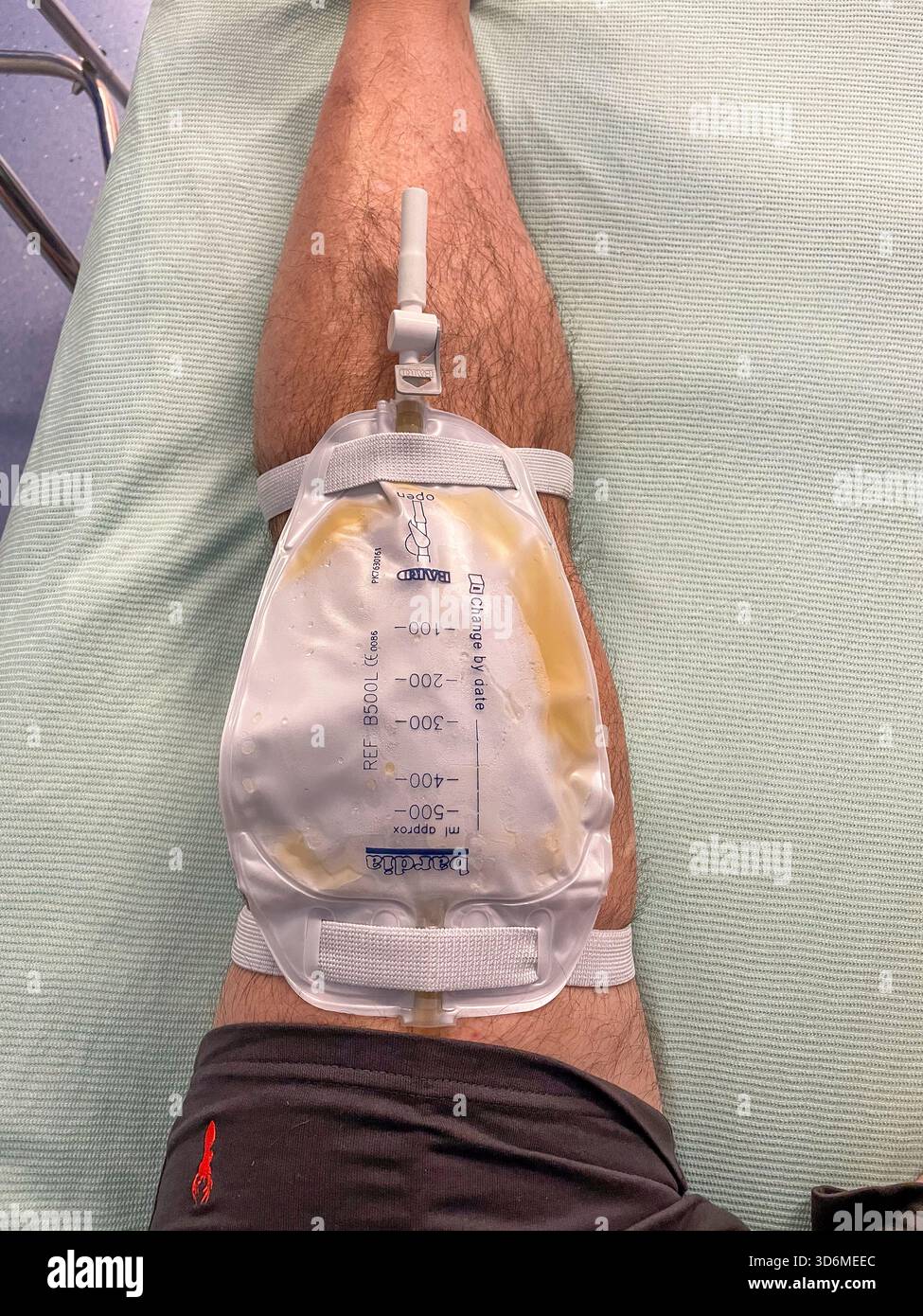 Catheter Bag Attached to Senior Man’s Leg in Clinical Setting – Medical Care and Mobility Support: Phillip Roberts - Smartphone Captured Stock Image
