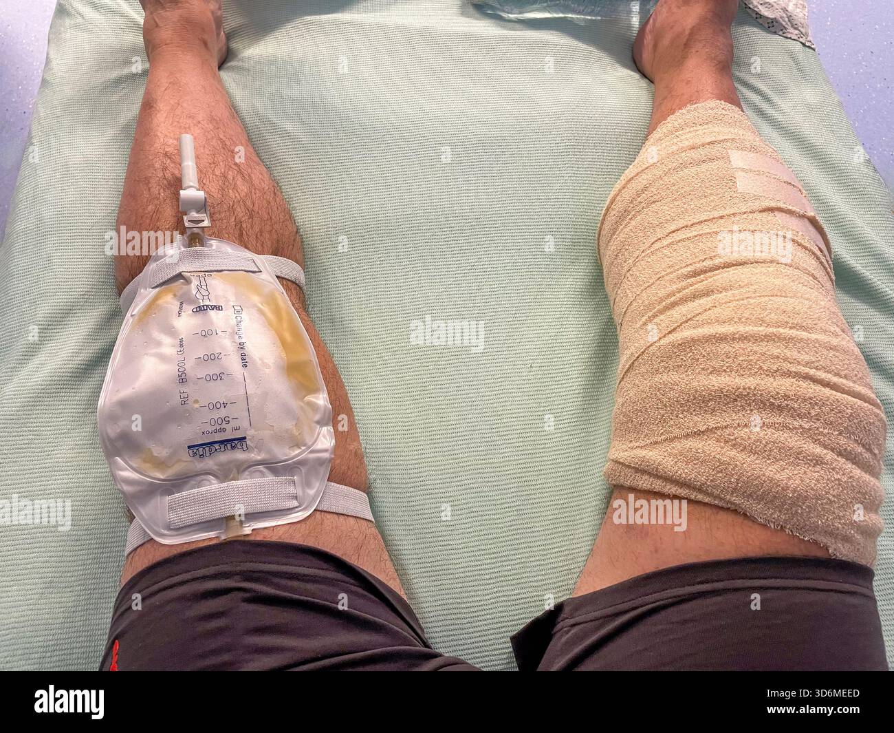 Catheter Bag Attached to Senior Man’s Leg in Clinical Setting – Medical Care and Mobility Support: Phillip Roberts - Smartphone Captured Stock Image