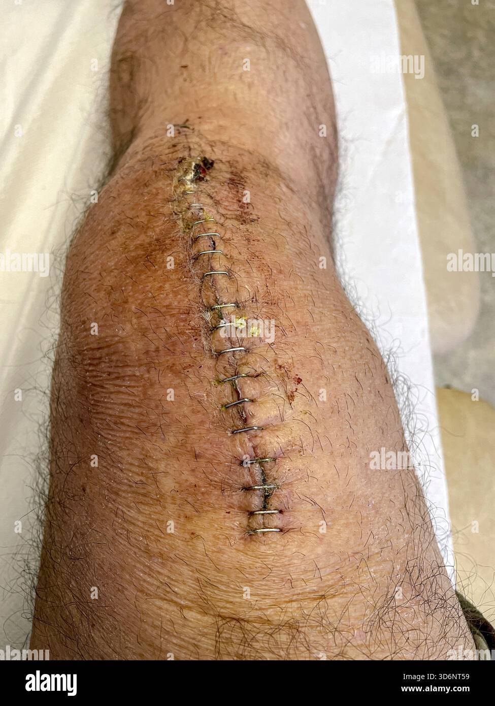 Clinical removal of surgical staples from a healing knee incision during post-operative care after total knee replacement: Phillip Roberts - Smartphone Captured Stock Image