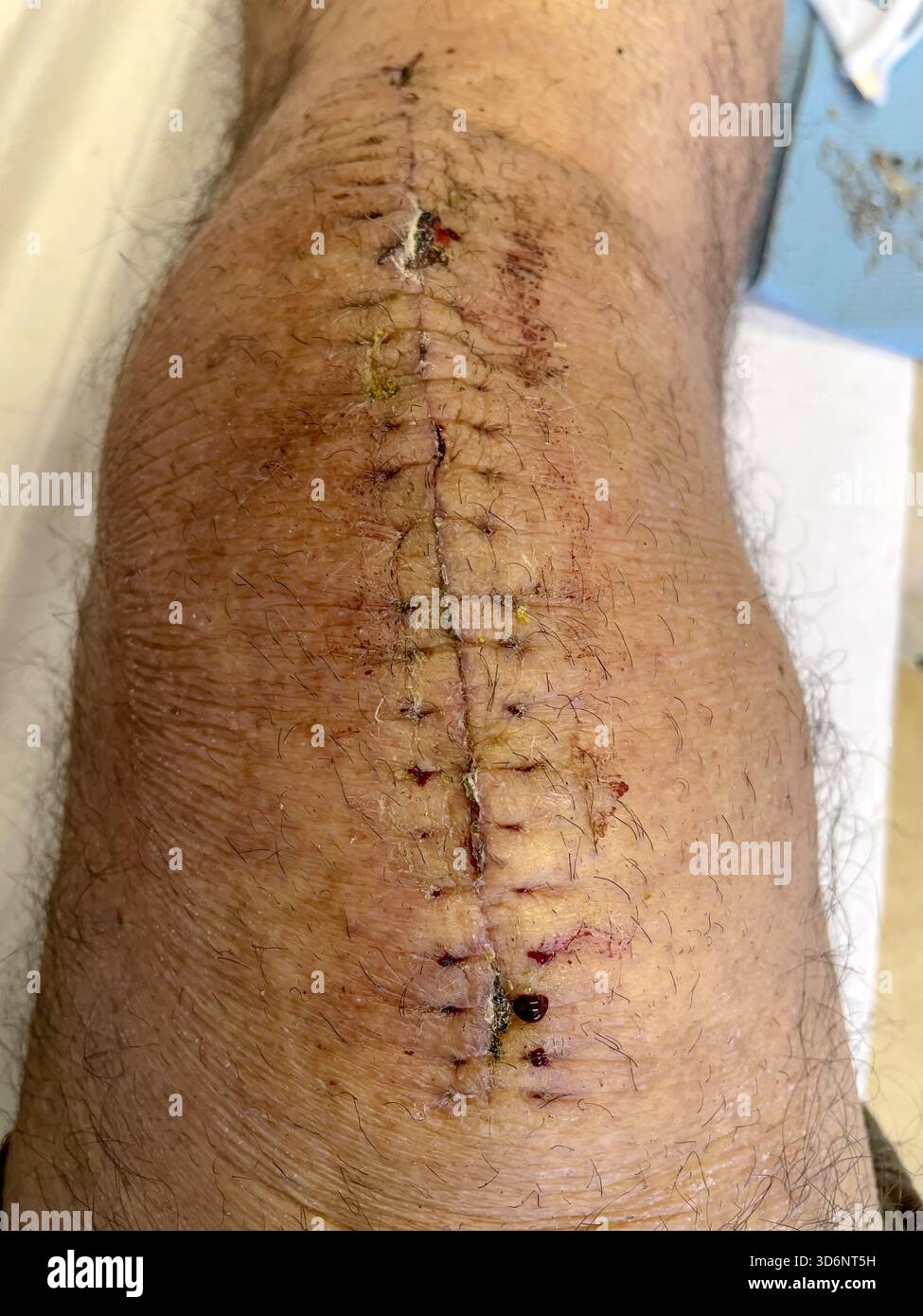 Clinical removal of surgical staples from a healing knee incision during post-operative care after total knee replacement: Phillip Roberts - Smartphone Captured Stock Image