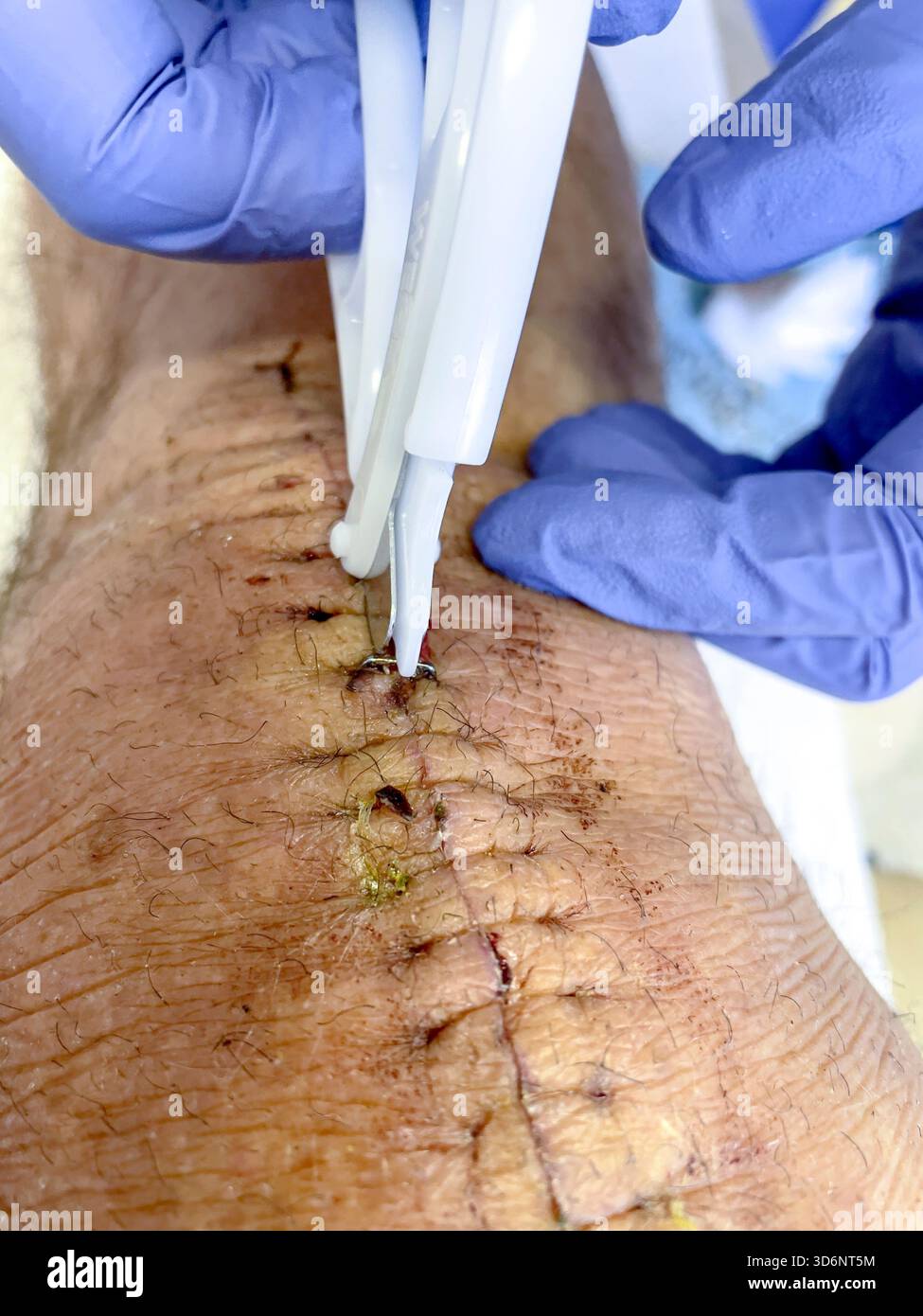 Clinical removal of surgical staples from a healing knee incision during post-operative care after total knee replacement: Phillip Roberts - Smartphone Captured Stock Image