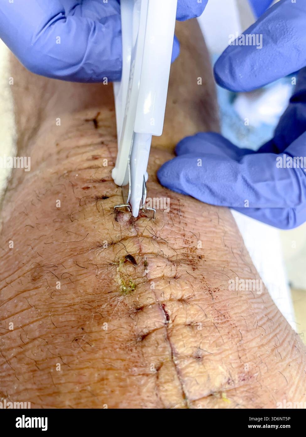 Clinical removal of surgical staples from a healing knee incision during post-operative care after total knee replacement: Phillip Roberts - Smartphone Captured Stock Image