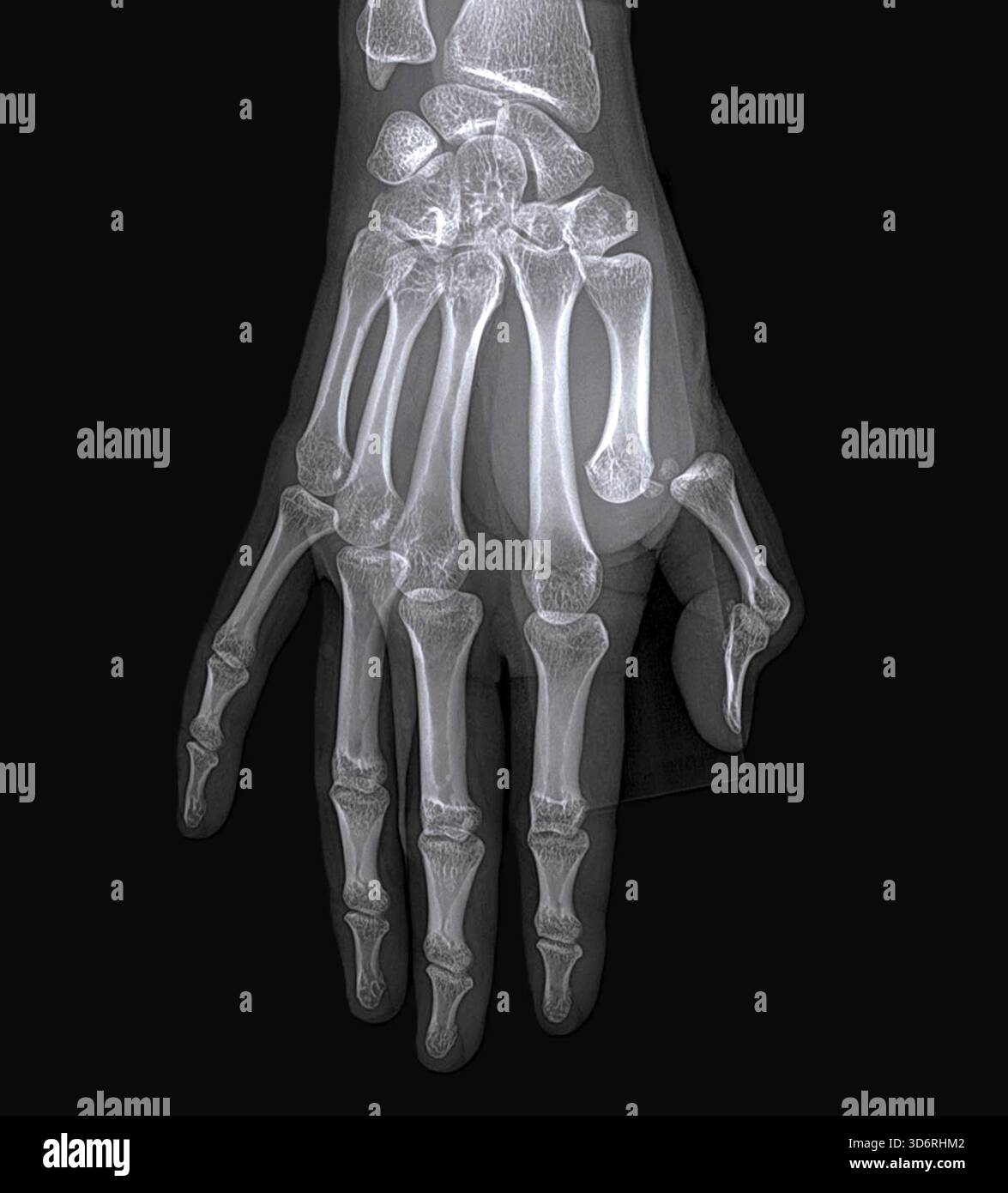 Thumb dislocation hi-res stock photography and images - Alamy, image size:1175x1390