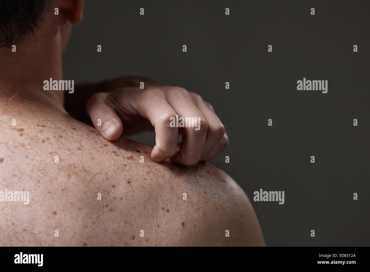 Middle Aged Caucasian Man Scratching Back Experiencing Skin Irritation Stock Photo
