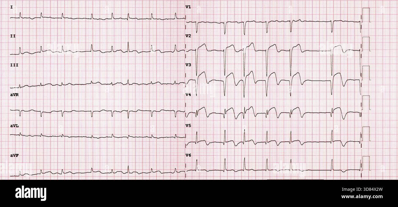 What Does An Anterior Infarct Look Like On An Ecg