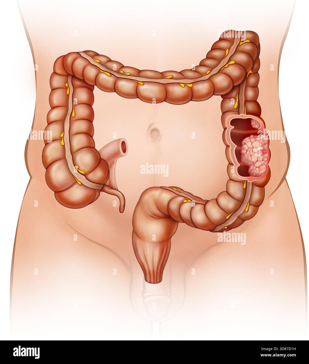Illustration of a human abdomen showing the large intestine with a ...