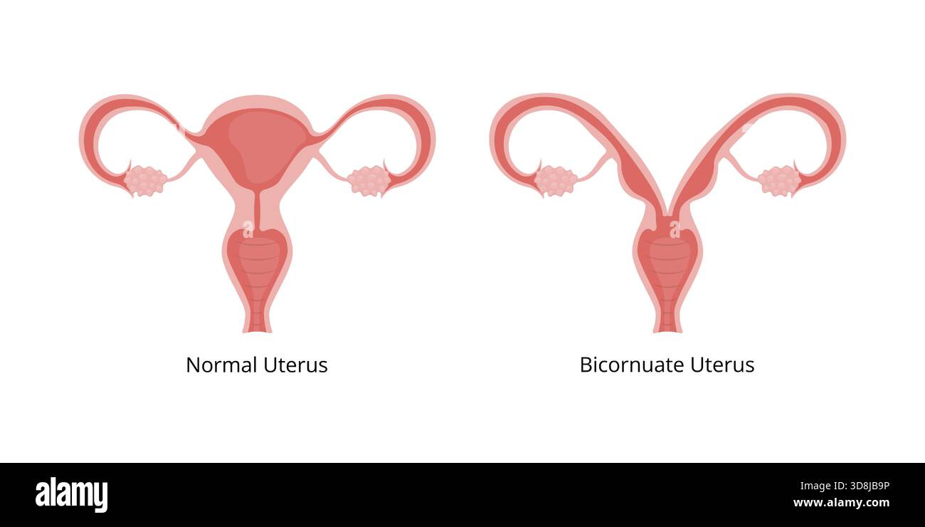 Bicornuate Uterus Stock Vector Images Alamy Bicornuate Uterus Stock Vector Images Alamy