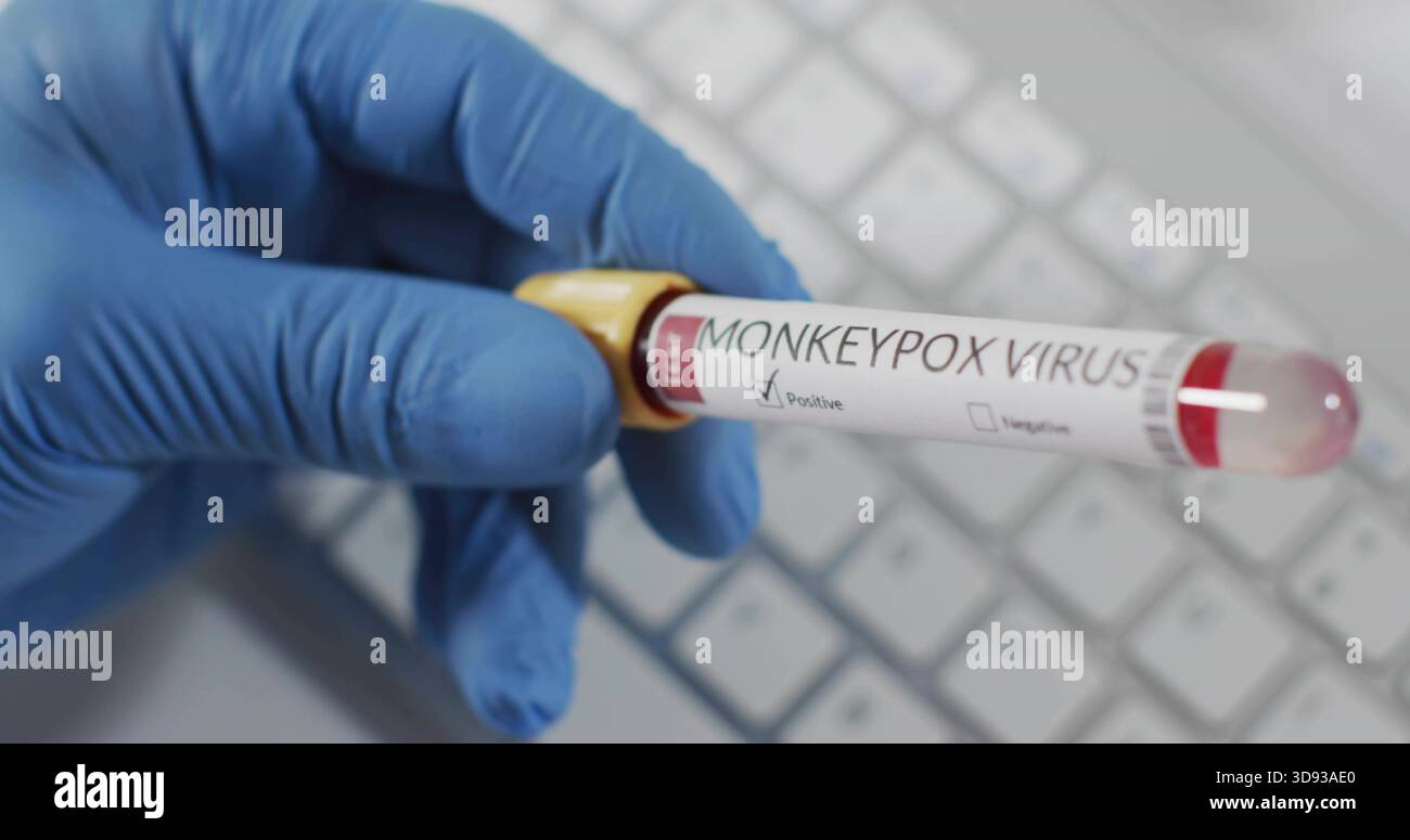 Holding blue-nitrile glove showing MONKEYPOX blood tube at lab desk, yellow cap, checked positive Stock Photo