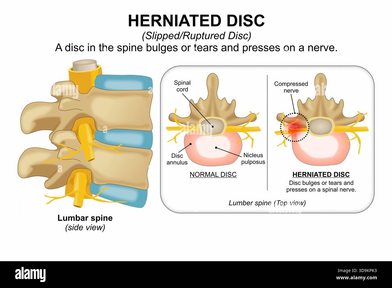 Herniated disc (Slipped/Ruptured Disc Stock Photo - Alamy