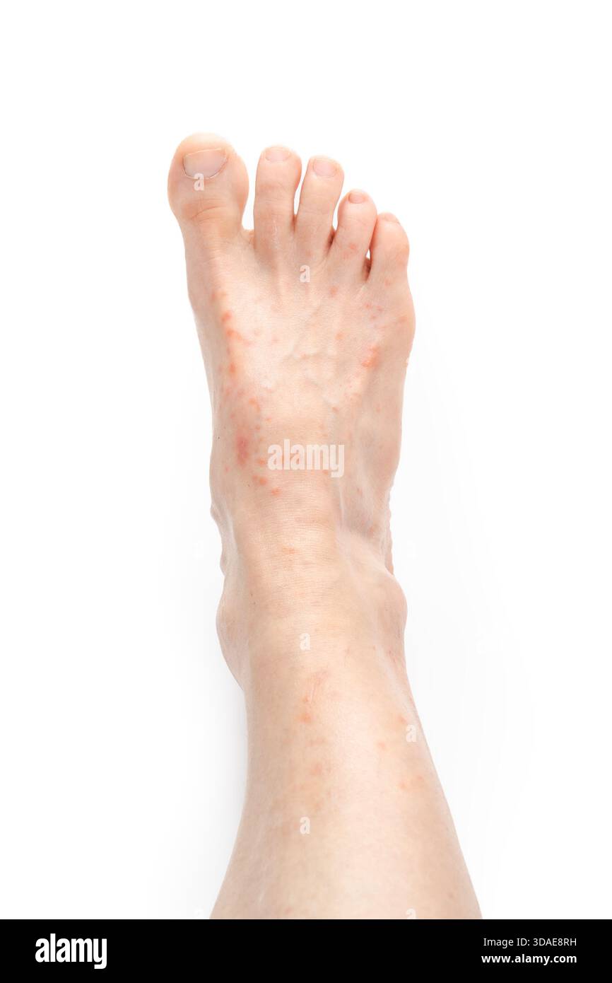 Bumpy Rash Isolated Sweat Rash On Feet