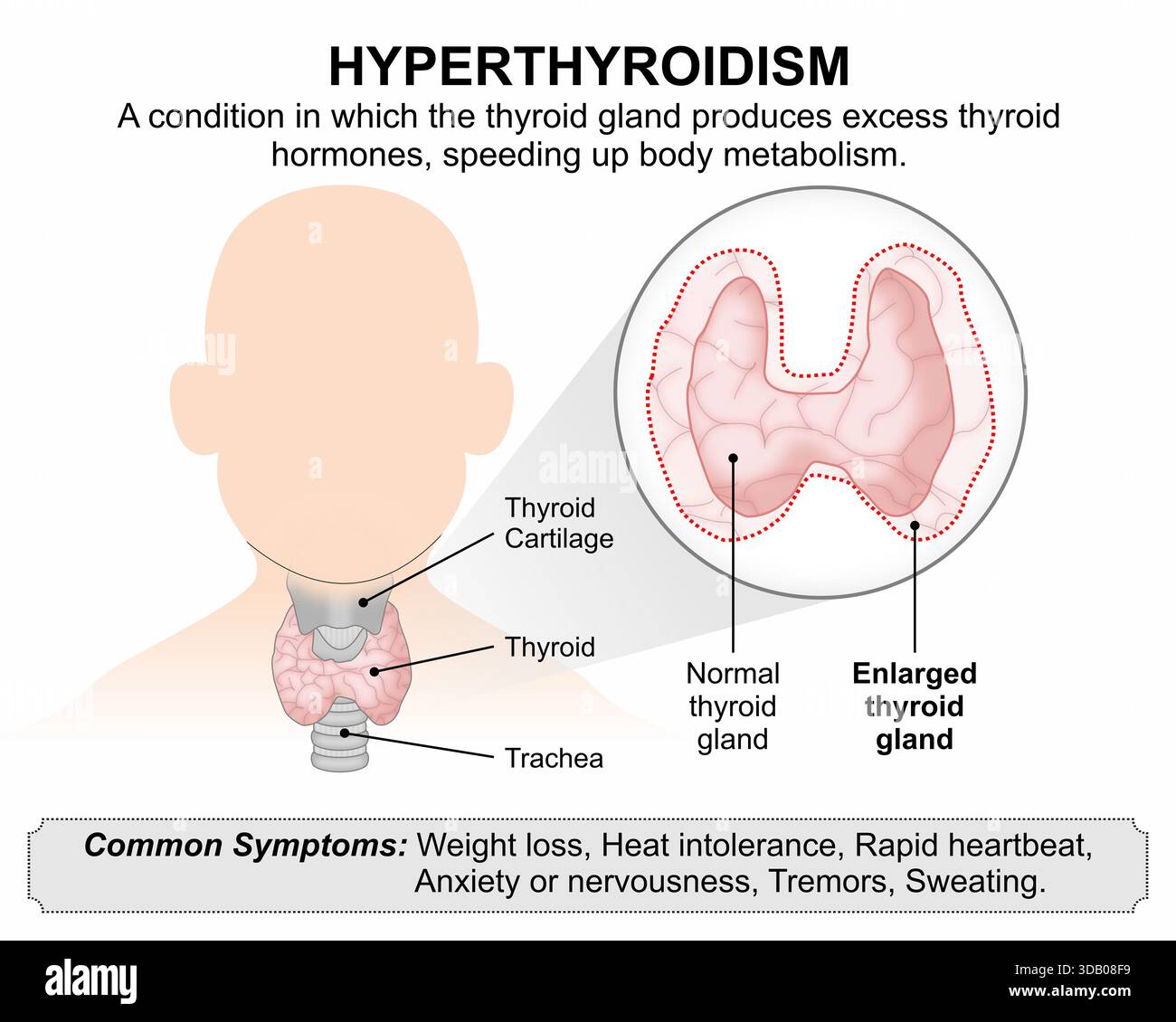 Hyperthyreosis Hyperthyroidism Medical Infographic Flashcard Illustration Stock Photo ...