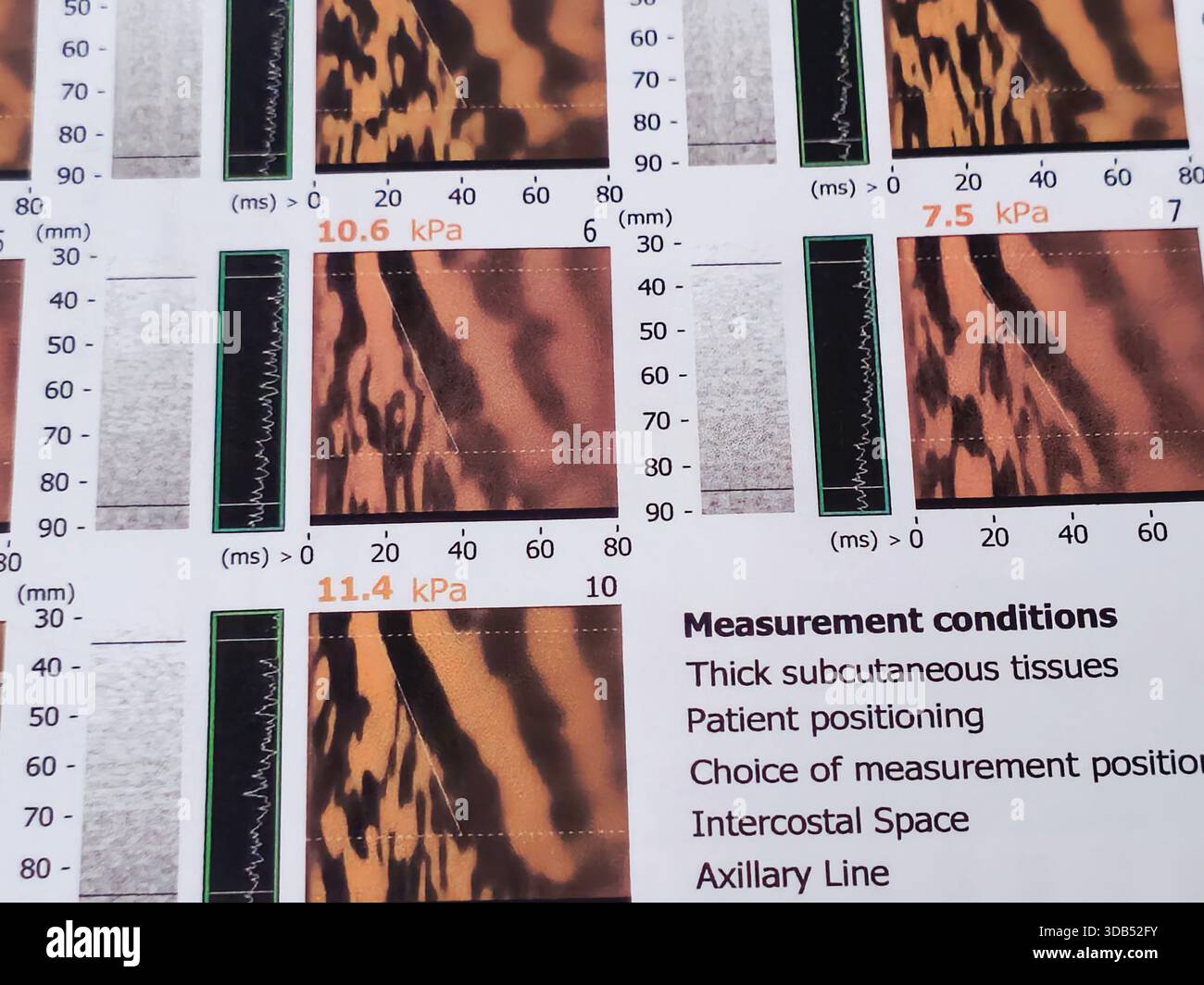 Fibroscan hi-res stock photography and images - Alamy