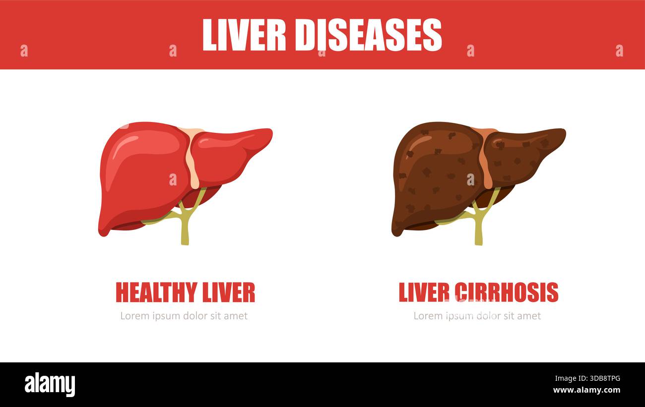 Liver disease. Healthy and cirrhosis liver. Internal organ icons ...