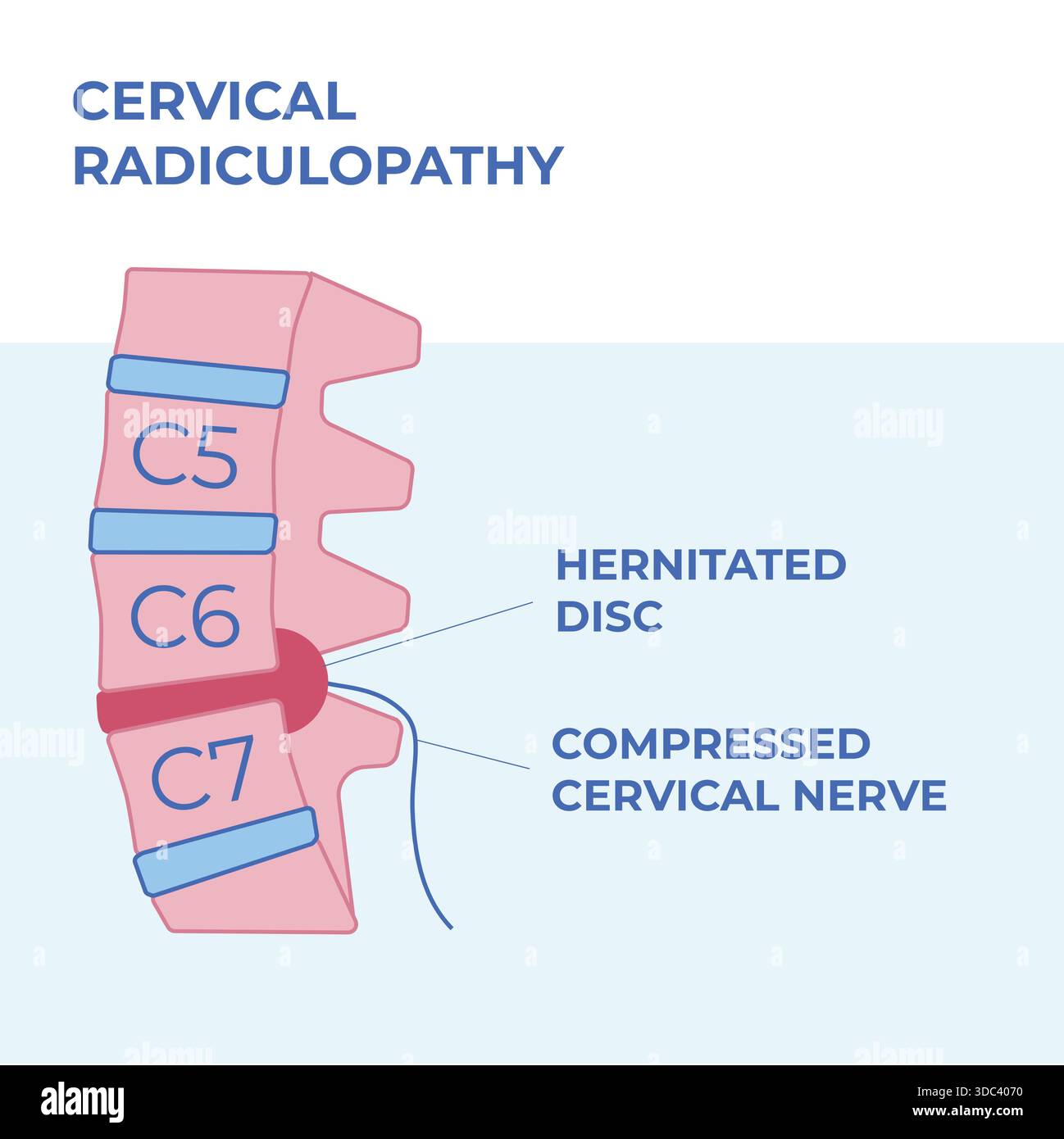 C6 c7 disc herniation radiculopathy hi-res stock photography and images ...