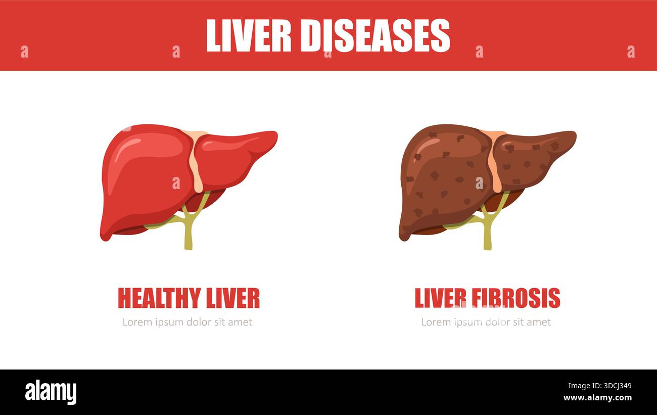 Liver disease. Healthy and fibrosis liver. Internal organ icons ...