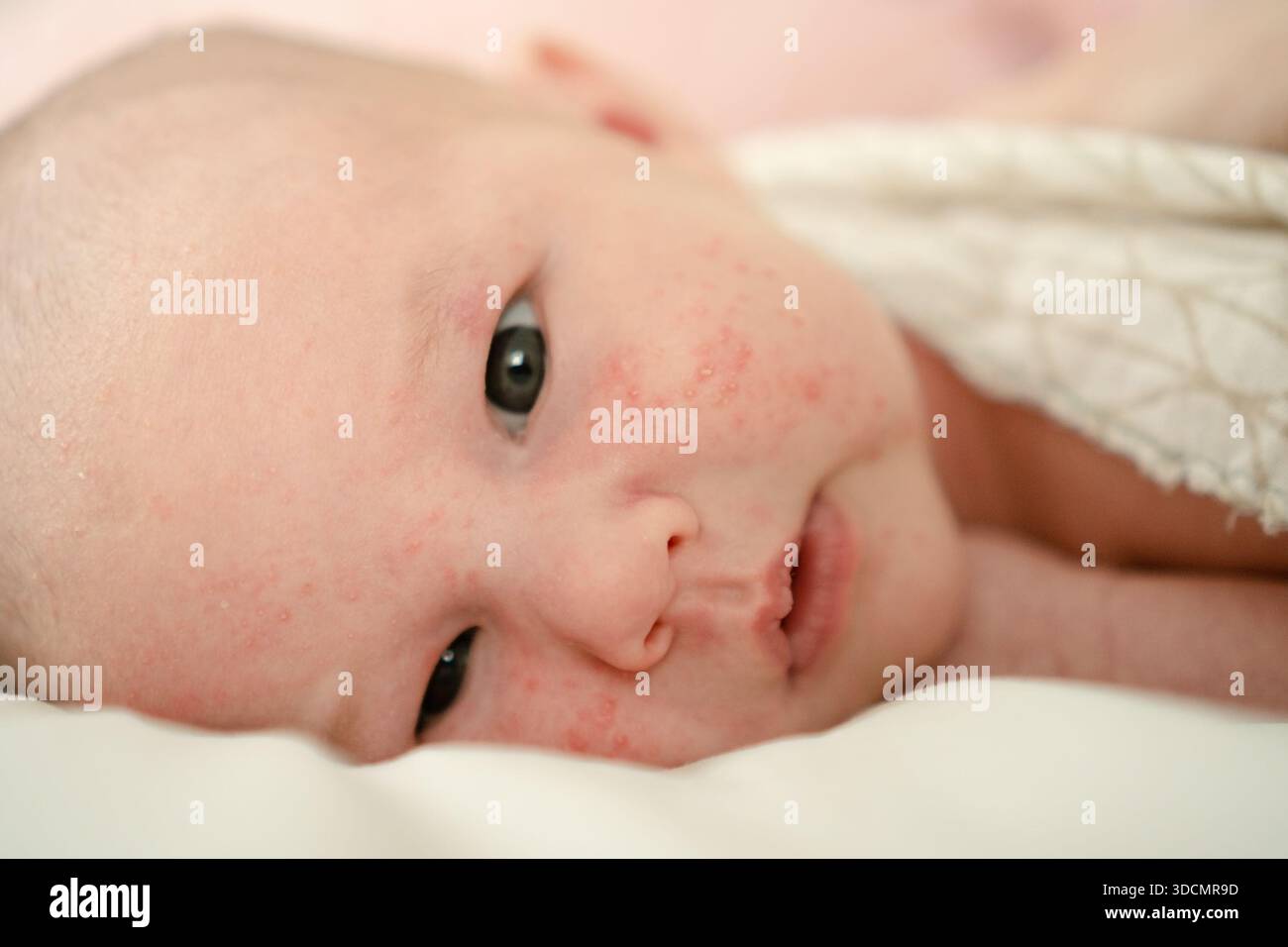 A peaceful newborn baby with visible skin rash and tiny red spots, resting on cozy white fabric. The babys serene expression reflects the natural adaptation process after birth. Stock Photo