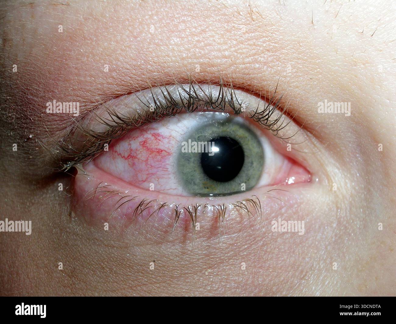 Purulent discharge from the eye of a patient with bacterial conjunctivitis. Conjunctivitis is inflammation of the conjunctiva, the membrane covering the white of the eye. A purulent condition is one where pus is produced, an exudate formed during an infection. Treatment is with antibiotics. Stock Photo