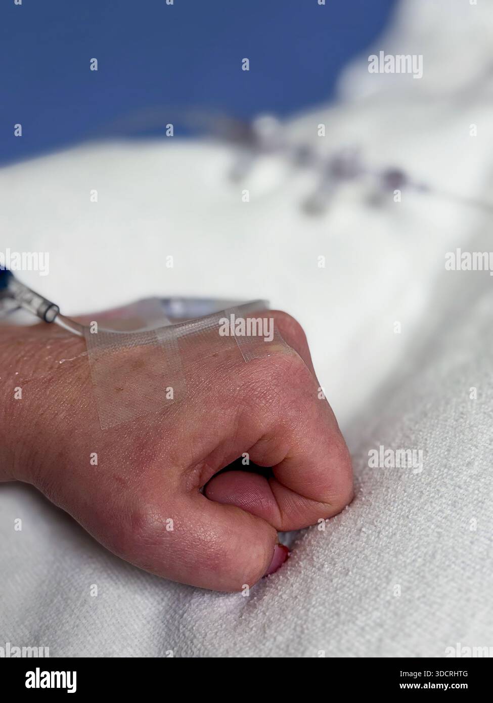 Closeup of an IV implant secured to a patient’s hand, tubing and ...