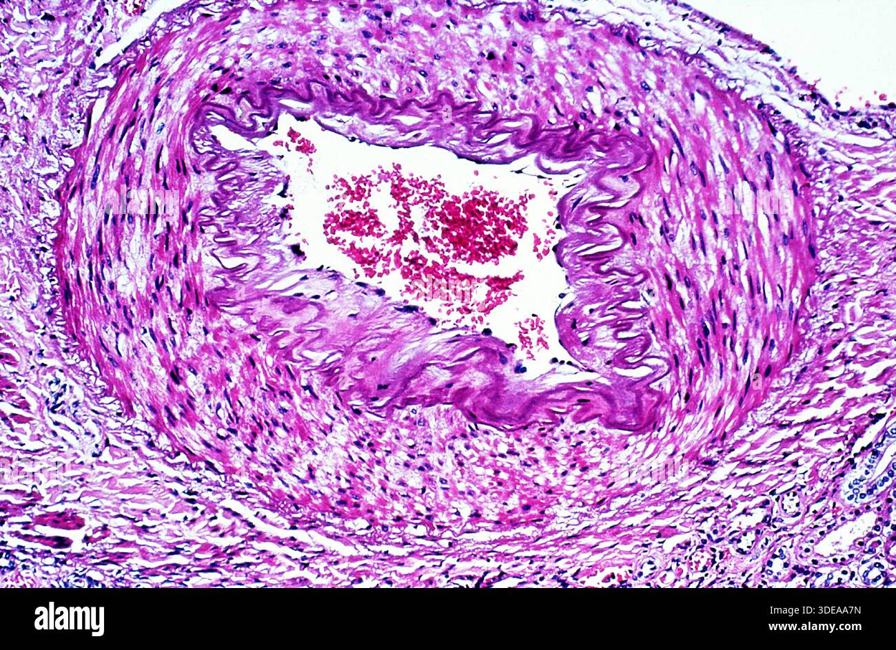 Arteriole in benign hypertension, under the microscope Stock Photo