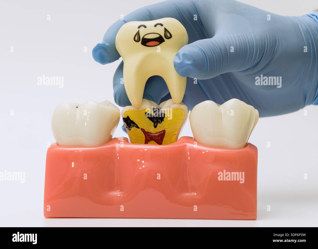 Crying cartoon tooth over decayed cross-section model Stock Photo - Alamy