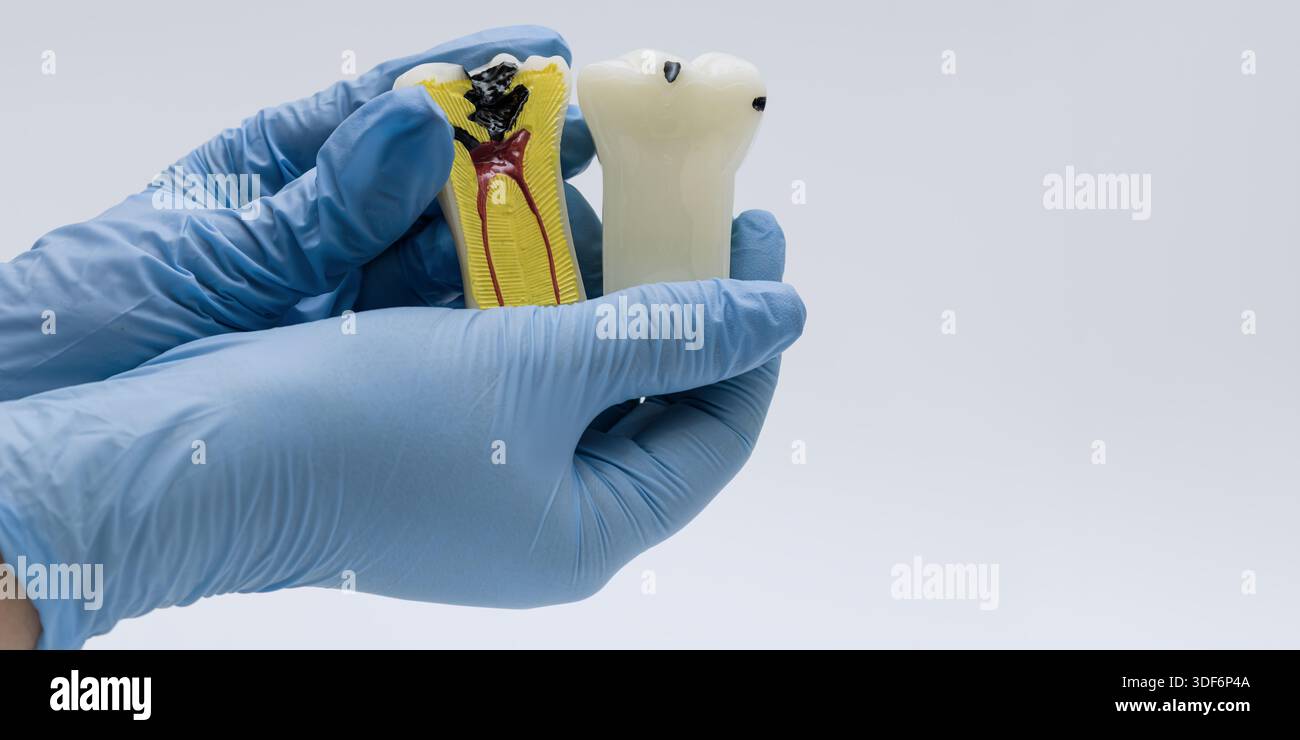 Pulp Hand Image Gloved hands hold two tooth models, one with visible surface decay and ...
