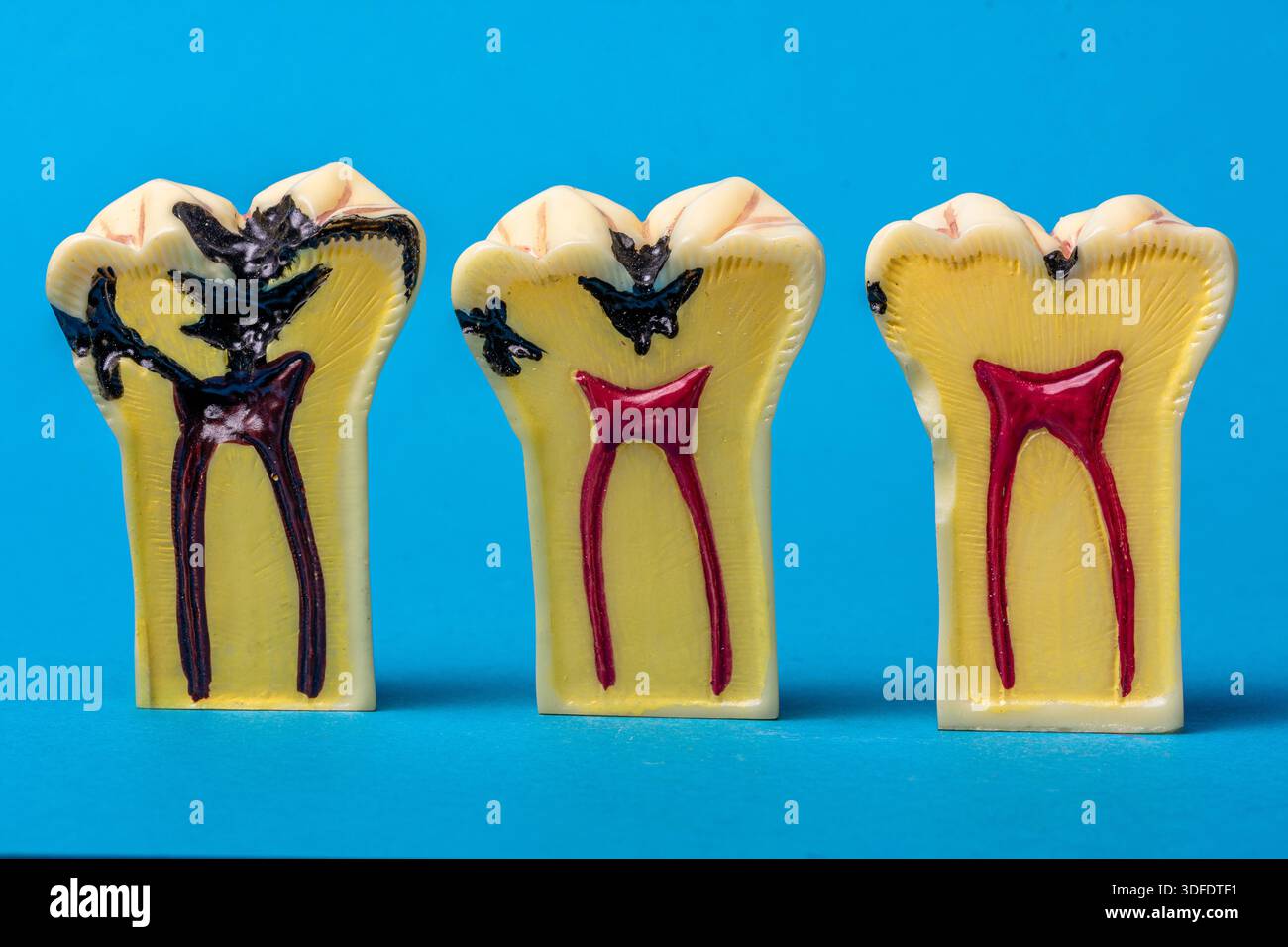 Diagram tooth caries stages hi-res stock photography and images - Alamy