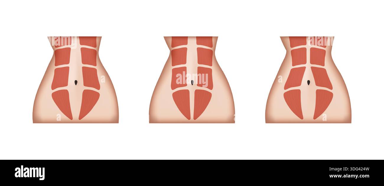 Different stages of diastasis recti showing abdominal muscles ...