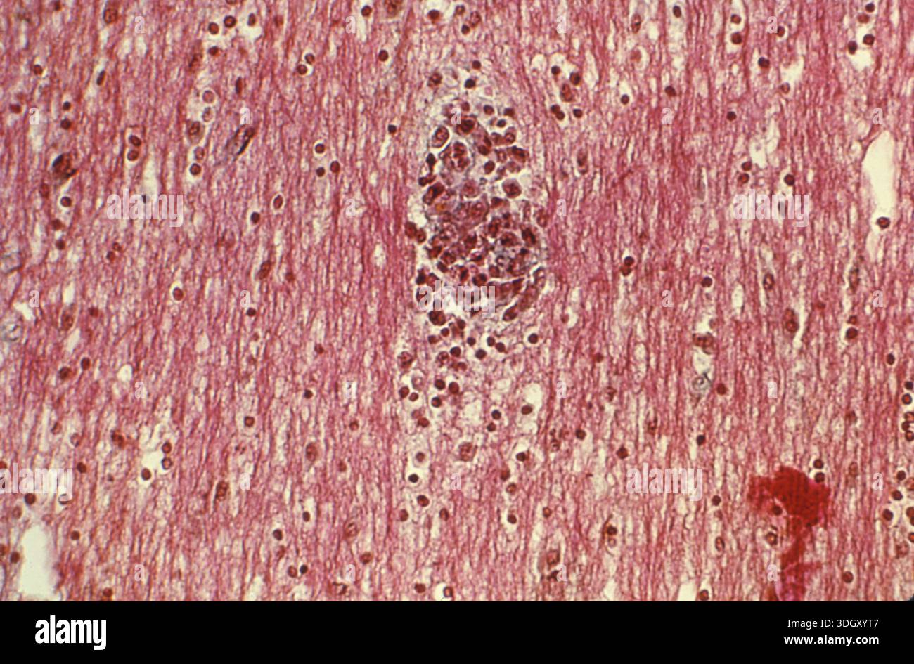 Photomicrograph of brain tissue showing a microglial nodule, with ...