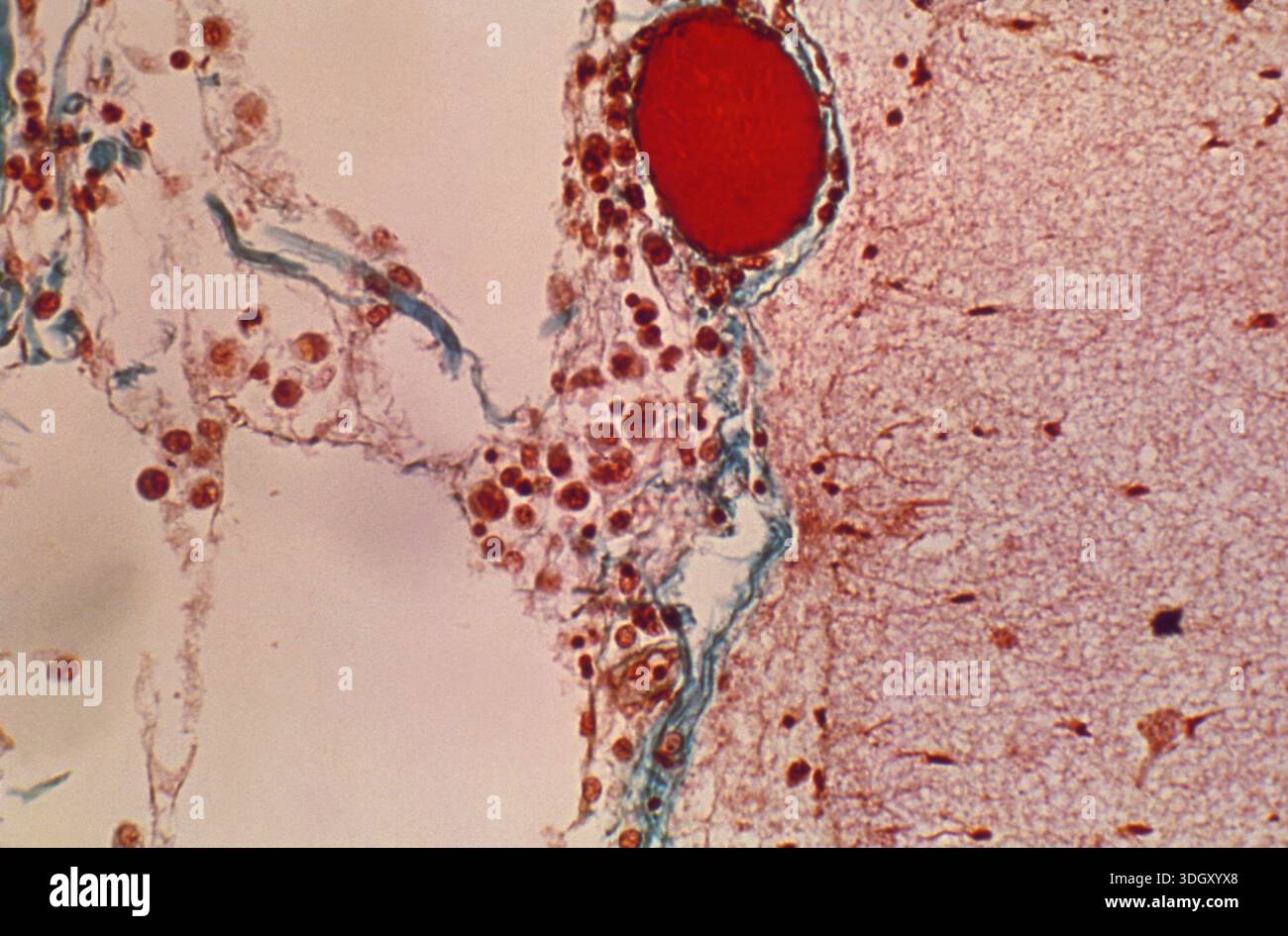 A photomicrograph shows a section of brain tissue with a meningeal ...