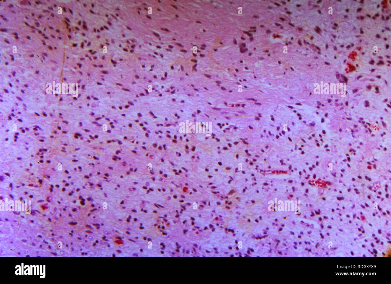 Photomicrograph of a human brain tissue biopsy showing astrocytoma ...