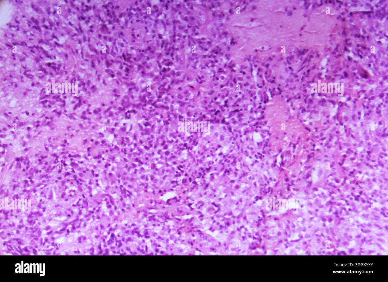 Photomicrograph of a human brain tissue biopsy showing astrocytoma ...