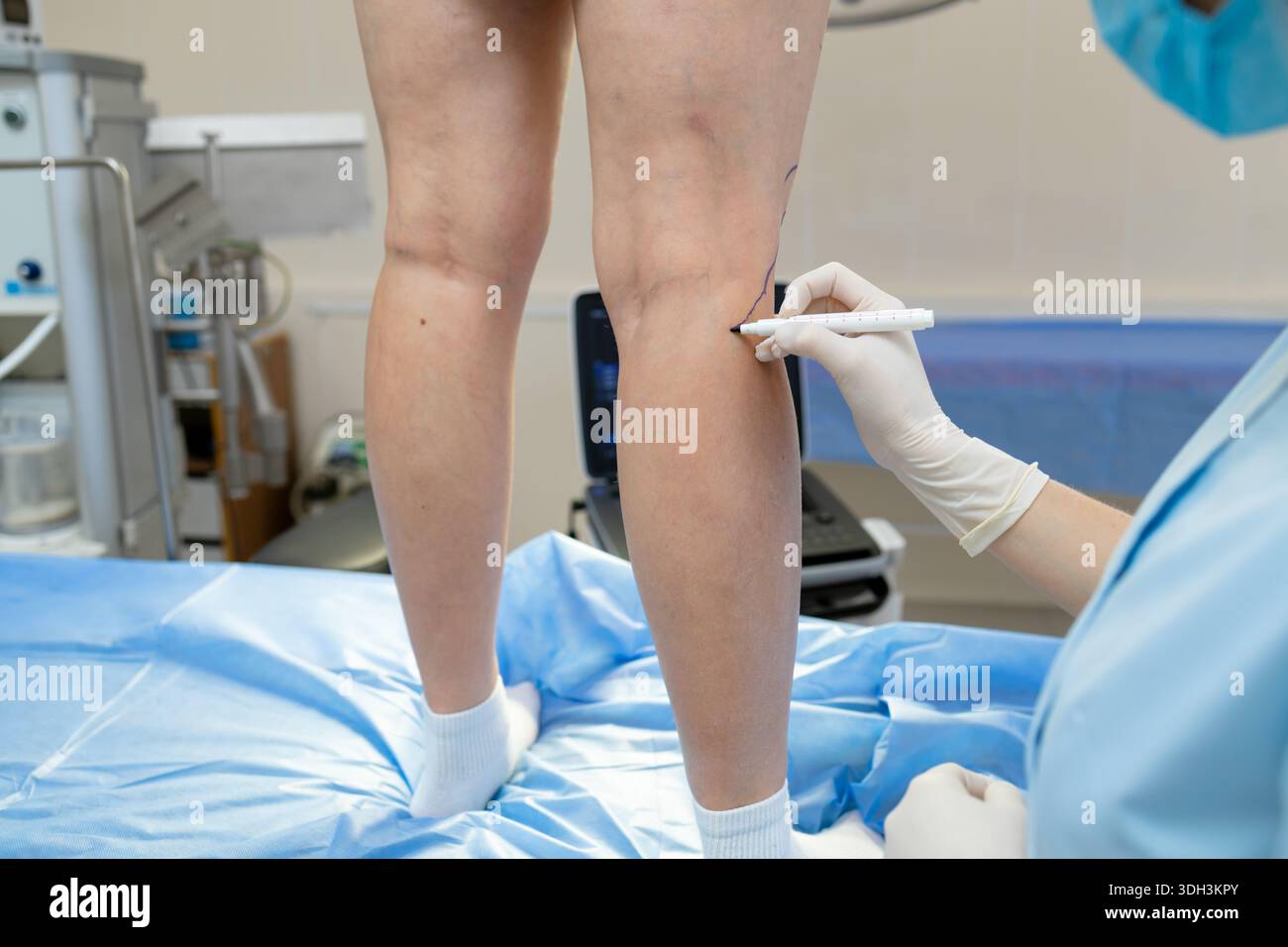 Preoperative leg vein assessment with markings Stock Photo - Alamy