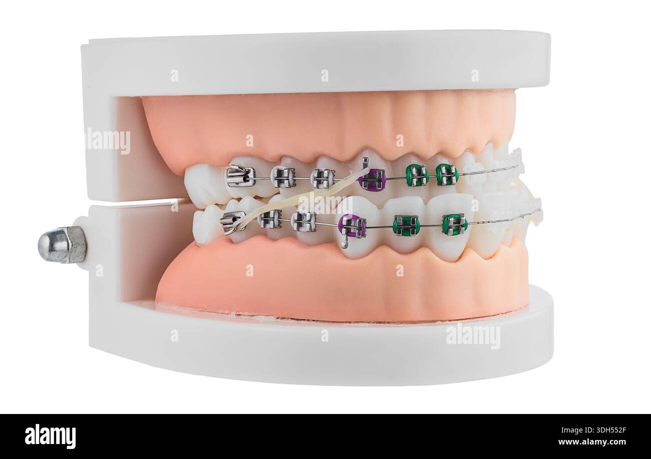 Dental Orthodontic Model With Braces Demonstrating Brackets, Wire, and ...