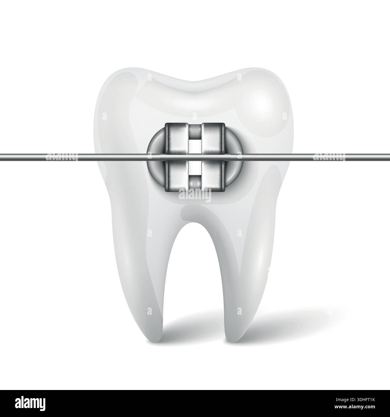 Vector 3d Tooth Braces Orthodontic Bracket. Dental Tooth with Metal ...