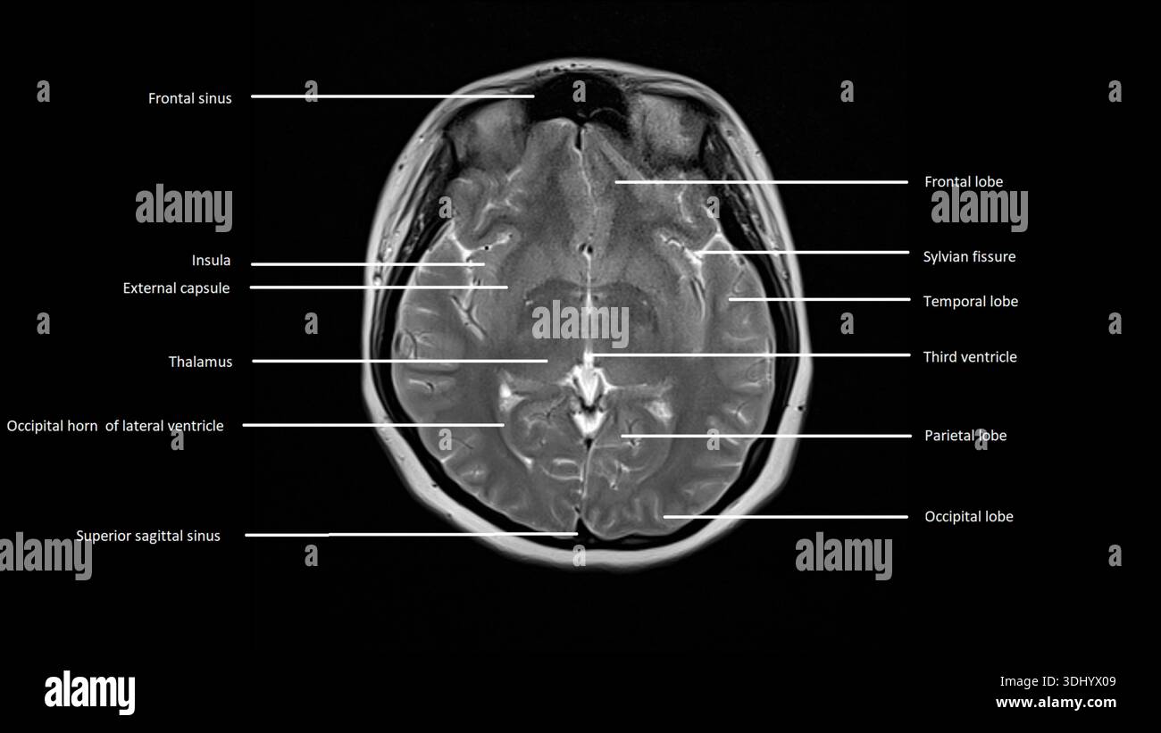 Labelled magnetic resonance imaging (MRI) scan of an axial section of a normal brain. Stock Photo