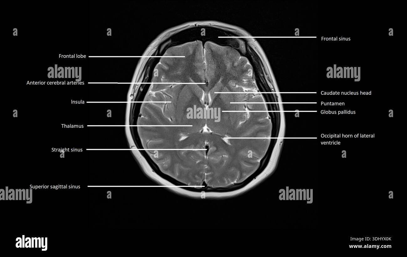Labelled magnetic resonance imaging (MRI) scan of an axial section of a normal brain. Stock Photo