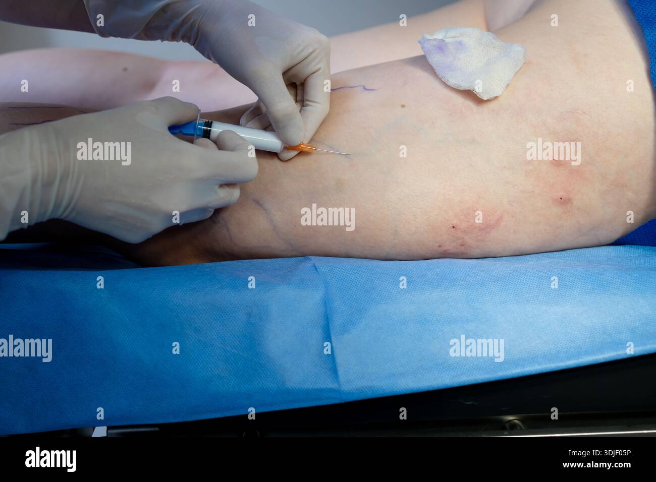 Sclerotherapy injections administered to treat spider and varicose ...
