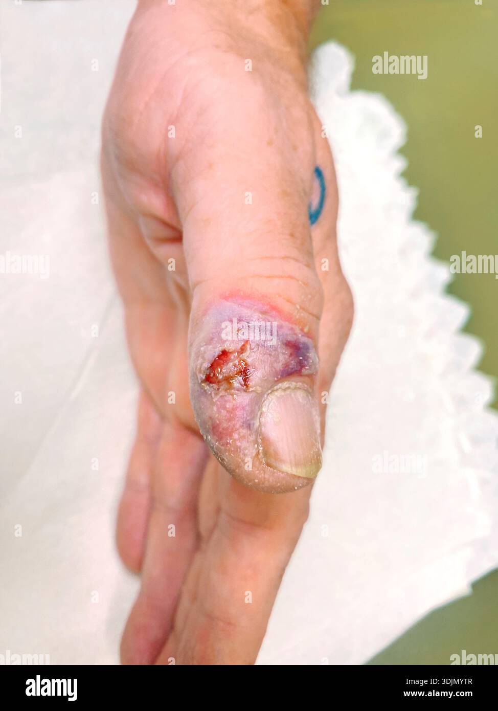 Streptococcus bacterial infection on a patient's finger after trauma. Streptococcus species are gram-positive bacteria that can enter the body through openings in the skin, such as cuts or abrasions, leading to localised infection. Symptoms include redness, swelling, pain and pus. Streptococcal skin infections can spread to surrounding tissues or enter the bloodstream if left untreated. Treatment typically involves antibiotics and appropriate wound care. Stock Photo