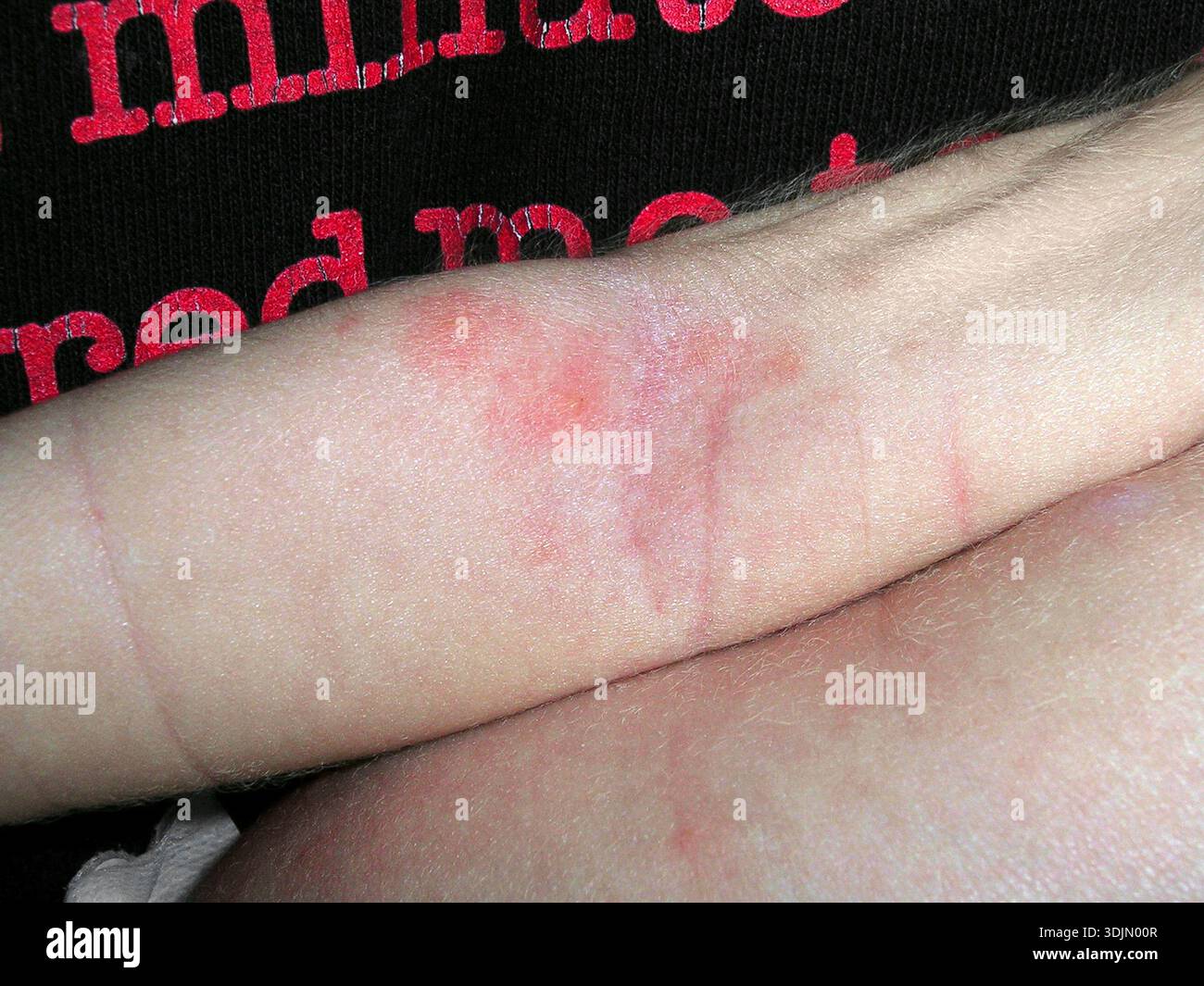 Erythema toxicum neonatorum in a 16 day old baby. Erythema toxicum ...