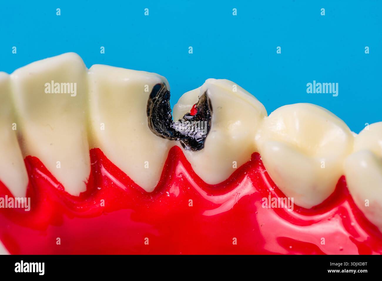 Dental decay showing deep cavity and caries on tooth model Stock Photo ...