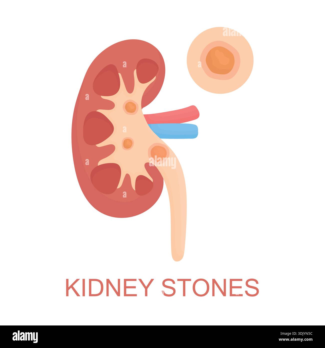 Vector illustration of a human kidney with stones isolated on white background. Clear visual concept of kidney problems, pain, discomfort Stock Vector