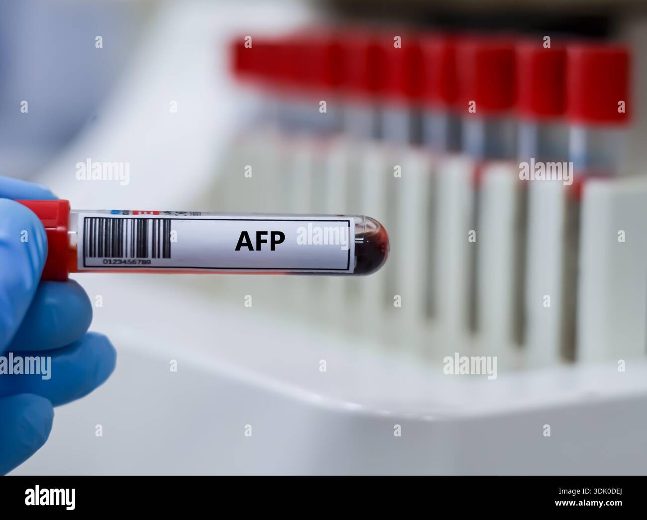Alpha fetoprotein hi-res stock photography and images - Alamy