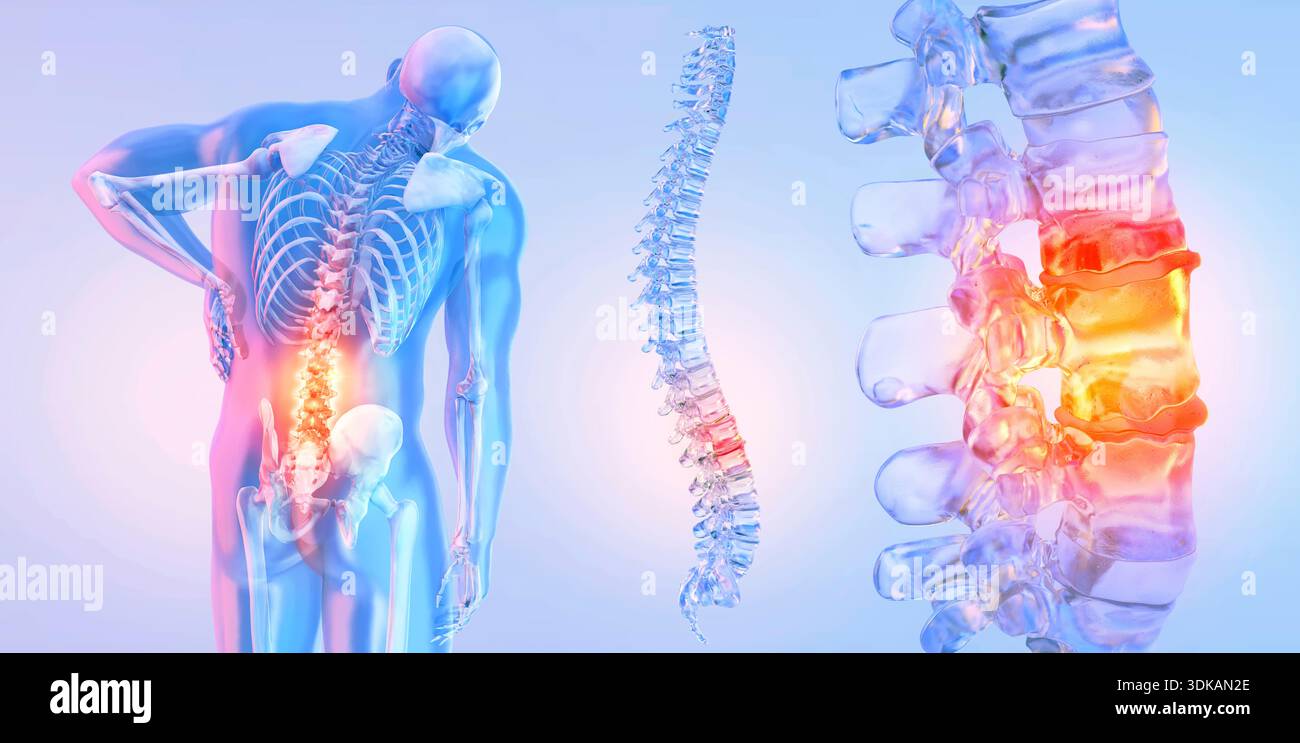 Back pain, conceptual illustration Stock Photo - Alamy