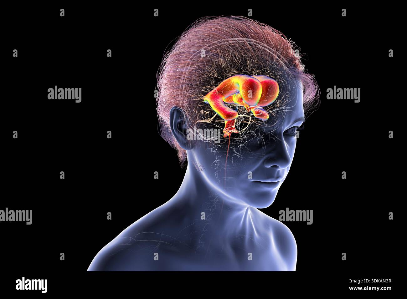 Compressed Brain Man Illustration of a human brain with normal pressure hydrocephalus ...