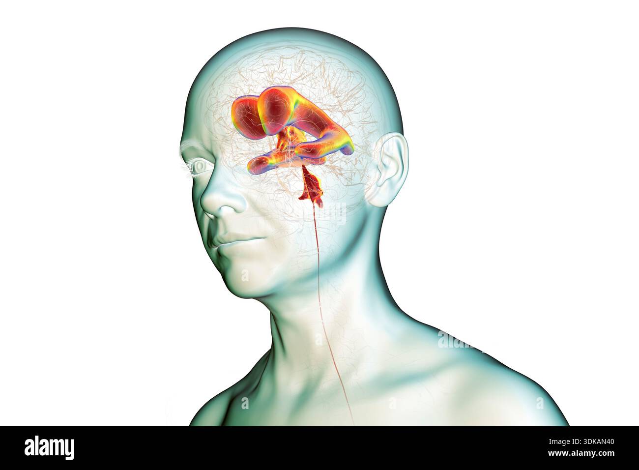 Compressed Brain Man Illustration of a human brain with normal pressure hydrocephalus ...